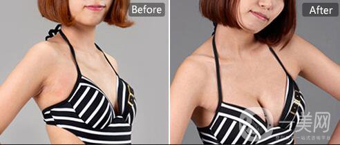 假體隆胸多久變得柔軟  多久徹底恢復