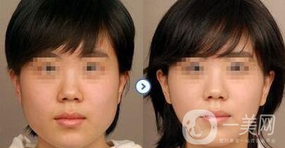 頰脂墊去除后還會長嗎 去頰脂墊*果保持多久