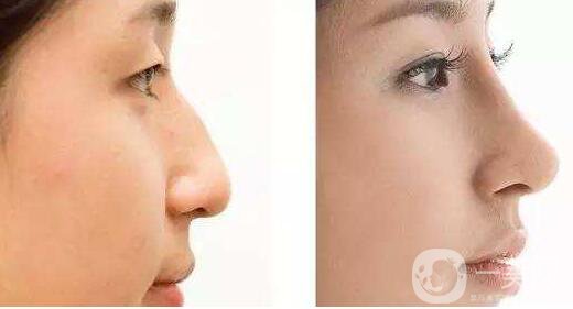 北京,墊鼻子,價(jià)格