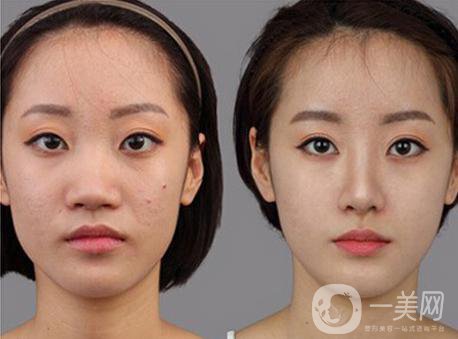 北京*整形多少錢(qián) 和哪些因素有關(guān)？