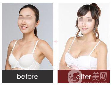 妙桃隆胸費用 價格詳情一覽