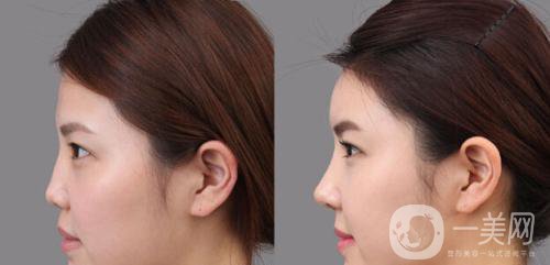 深圳*隆鼻大概多少錢 參考價格分析