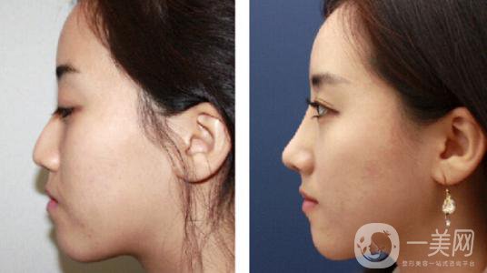 *術后要忌口嗎？術后注意事項有哪些？