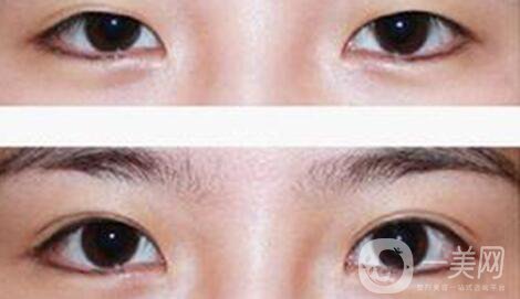 八月割雙眼皮會(huì)發(fā)炎嗎 雙眼皮術(shù)后護(hù)理事項(xiàng)介紹