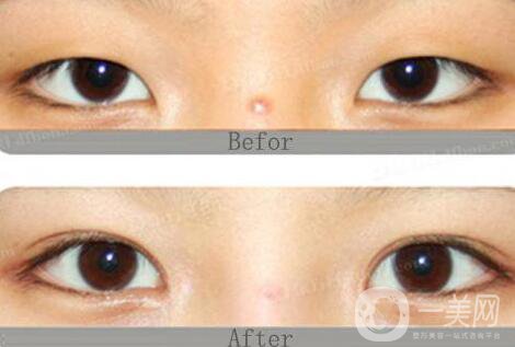 八月割雙眼皮會(huì)發(fā)炎嗎 雙眼皮術(shù)后護(hù)理事項(xiàng)介紹