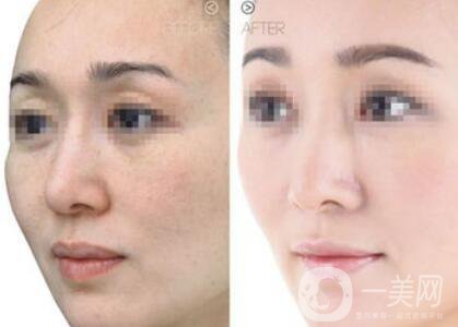 嫩膚多少錢 醫(yī)療美容嫩膚價(jià)格詳解