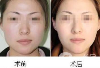 去頰脂墊多久消腫 去頰脂幾天能恢復(fù)