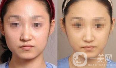 去頰脂墊多久消腫 去頰脂幾天能恢復(fù)