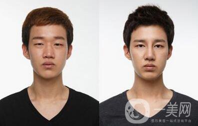 男生割雙眼皮會(huì)變帥嗎？