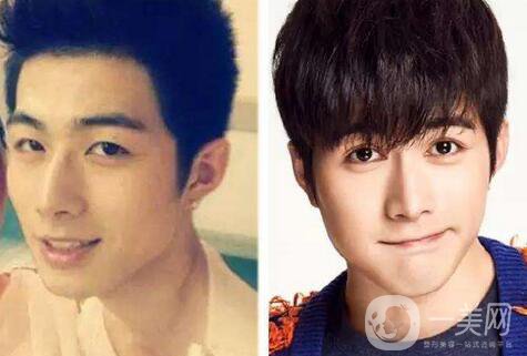 男生割雙眼皮會(huì)變帥嗎？