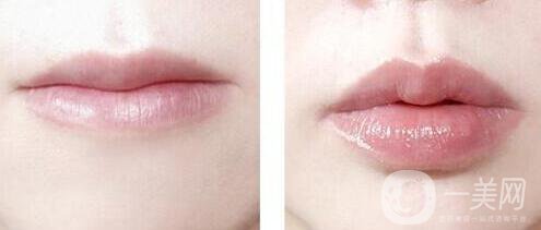 豐唇需要多少錢 豐唇價格詳解