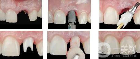 種植牙能用多長時間 種植牙能保持多久