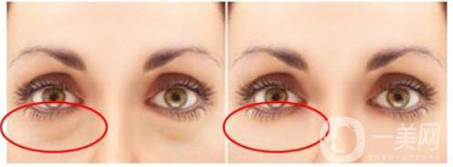 超聲波祛眼袋能保持多久 *果維持幾年