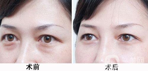 超聲波去眼袋大概多少價(jià)格 費(fèi)用詳情一覽