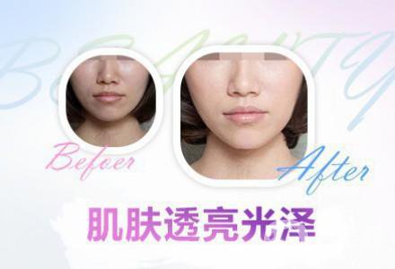 果酸換膚的功* 有哪些好處？