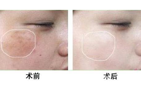 做皮膚鐳射凈膚需要多少錢？