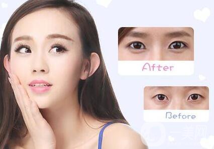 上海,韓式三點雙眼皮,價格