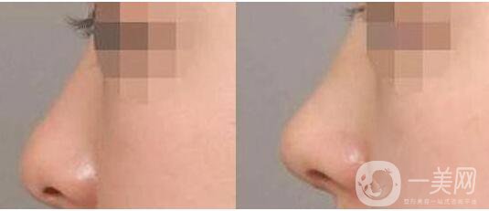 上海,玻尿酸隆鼻,價(jià)錢