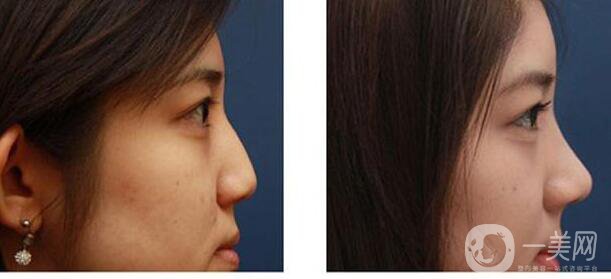 北京,自體脂肪隆鼻,多少錢