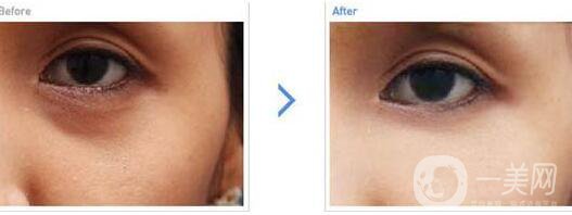 玻尿酸去黑眼圈,術(shù)后護(hù)理