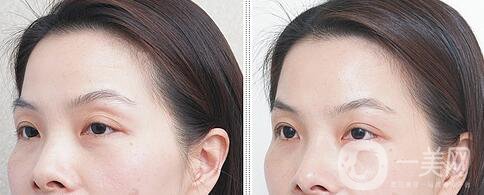 自體脂肪豐眼窩缺點(diǎn) 自體脂肪豐眼窩為什么不好
