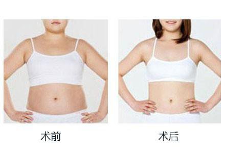 360度環(huán)形吸脂有哪些術(shù)后注意事項(xiàng)？