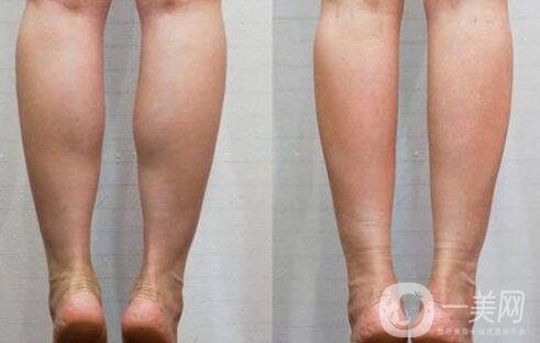 *有用嗎 小腿肌肉肥大注射*怎么樣