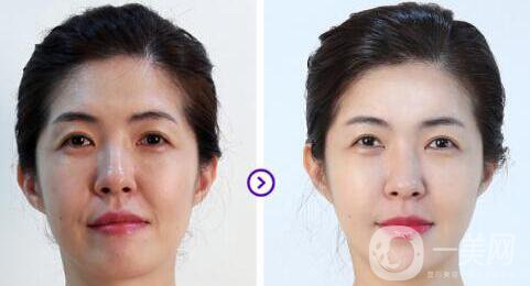 飛頓彩光嫩膚*果如何 飛頓彩光嫩膚前后圖