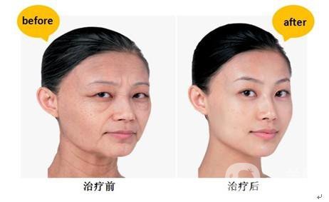 *生物除皺*果怎么樣？能持續(xù)多久？