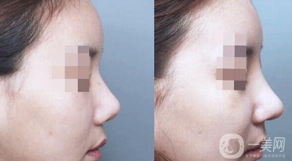 隆鼻后消腫的方法 隆鼻后怎么護理恢復快