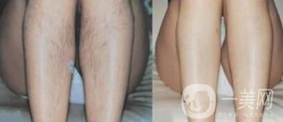 激光脫毛信息介紹 哪個(gè)醫(yī)院做激光脫毛好