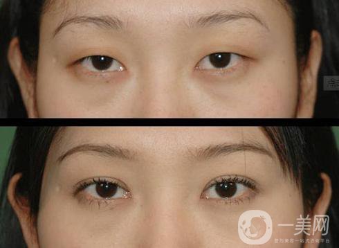 北京哪家醫(yī)院割雙眼皮*果好？