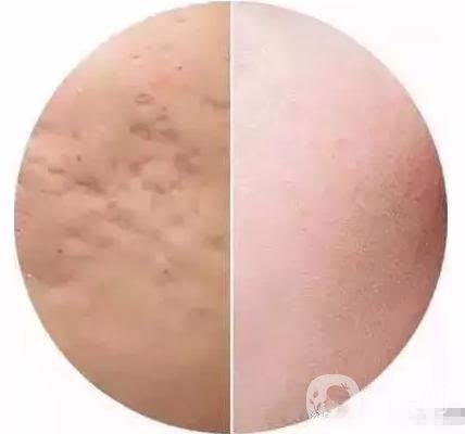 快速*去痘印的方法有哪些？