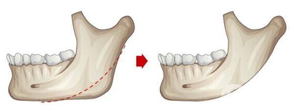 磨骨手術(shù)做完有些什么后遺癥？