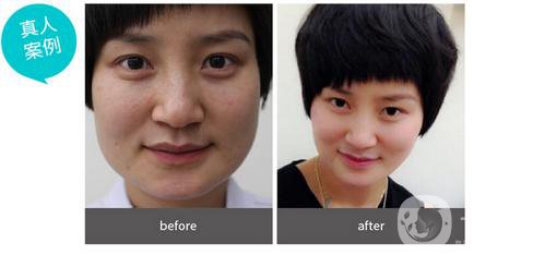 磨骨手術(shù)做完有些什么后遺癥？