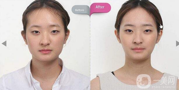 面部磨骨手術(shù)價(jià)格 面部磨骨手術(shù)多少錢