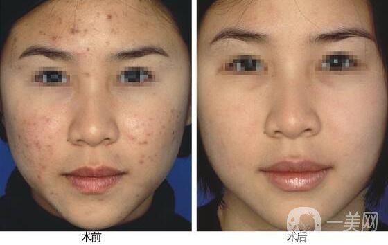 像素激光去痘,價(jià)格