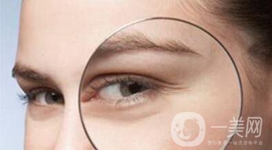 表情紋怎么去除 去表情紋*果怎么樣