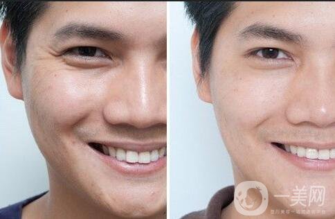 表情紋怎么去除 去表情紋*果怎么樣