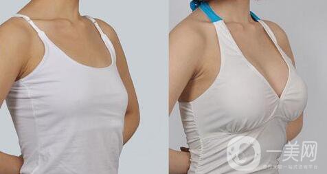 妙桃豐胸一次多少錢 妙桃假體隆胸具體價(jià)格