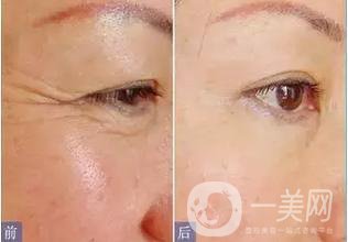 *去魚尾紋*嗎 *果怎么樣？