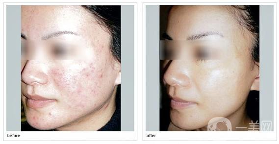 做一次果酸換膚大概需要多少錢？