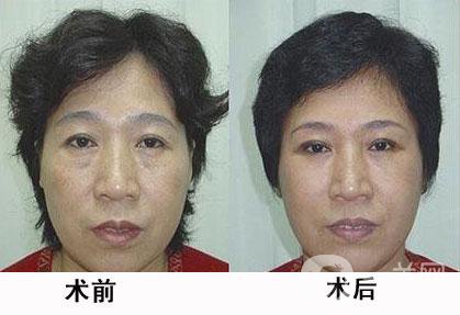 熱瑪吉除皺*果怎么樣？有哪些優(yōu)勢(shì)？