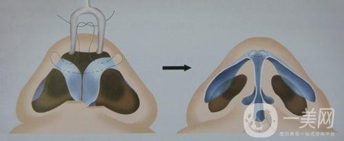 耳軟骨墊鼻梁大概需要多少錢呢？