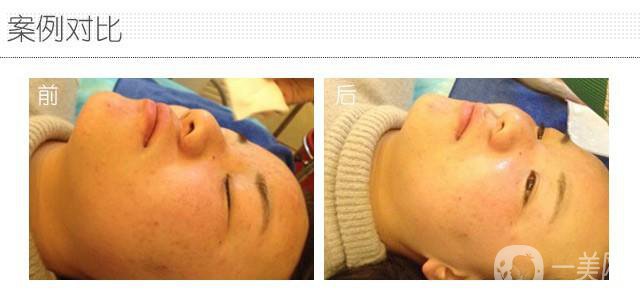 果酸換膚術(shù)做一次多少錢？