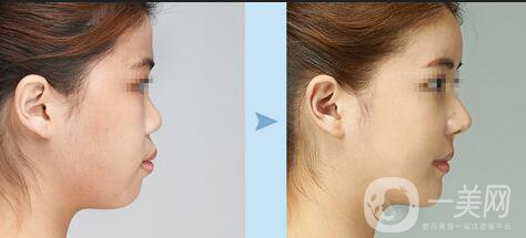 雙下巴抽脂手術(shù)一般需要多少錢？