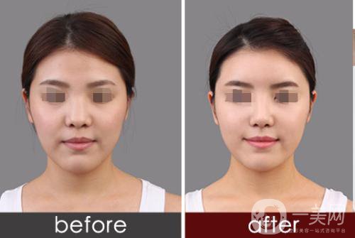 專業(yè)隆鼻修復(fù)手術(shù)的價格一般是多少？