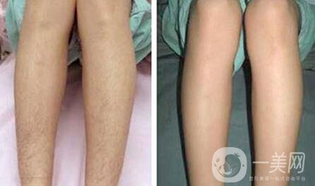 激光脫毛有哪幾種 激光脫毛是*的嗎