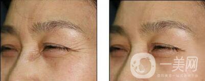 *注射去皺*果好嗎 *除皺怎么樣