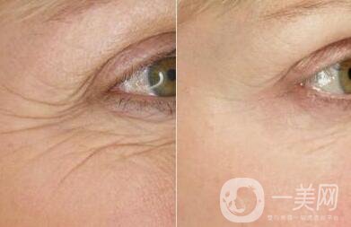 *注射去皺*果好嗎 *除皺怎么樣